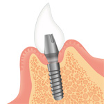 Step4.人工歯の装着（治療完了）