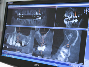 歯科放射線学会指導医による正確な診断